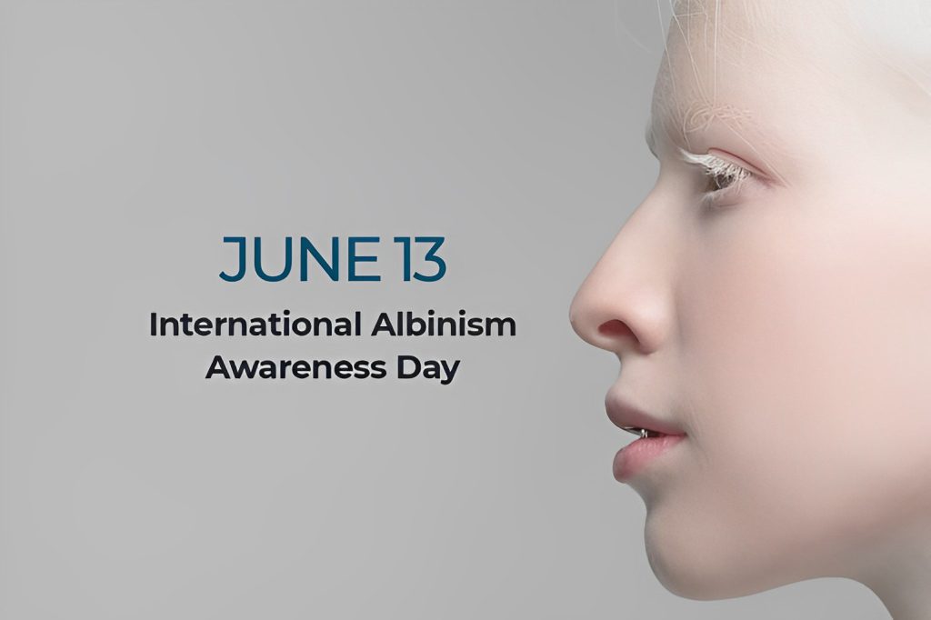 به‌مناسبت «روز جهانی آگاهی از آلبینیسم»